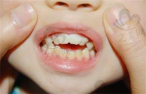 小孩子牙齿不整齐是什么原因引起的?你注意到了几个