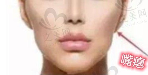 矫正拔四颗牙齿嘴瘪了怎么办,种植牙能不能恢复