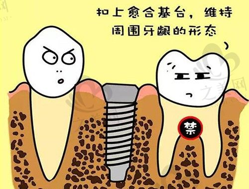 走一波德国种植牙品牌及价格,含ICX费亚丹植体优势介绍
