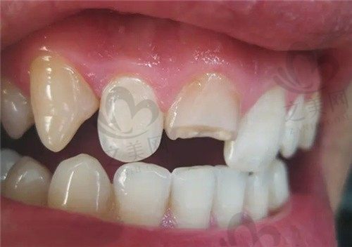 牙齿断掉了一半只剩根部怎么办?断了不去处理的后果是什么
