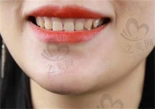全瓷牙贴面牙不齐可以做吗,跟全瓷牙的区别在哪有无伤害