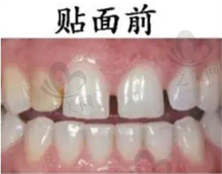 瓷贴面只做一颗可以吗?如果只做门牙色差大吗?