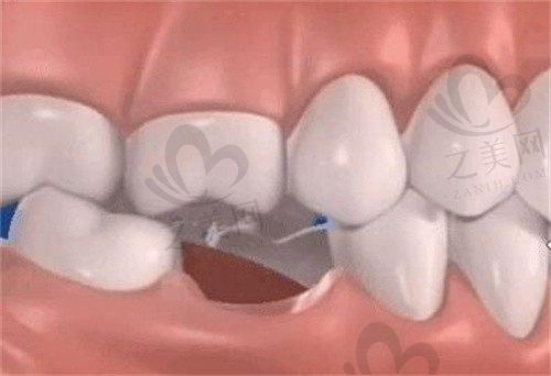 我35牙齿掉了镶牙还是种牙,两者有啥区别哪个更好呢?
