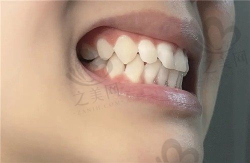 30岁深覆合有必要做矫正吗?深覆合一定要做矫正吗?