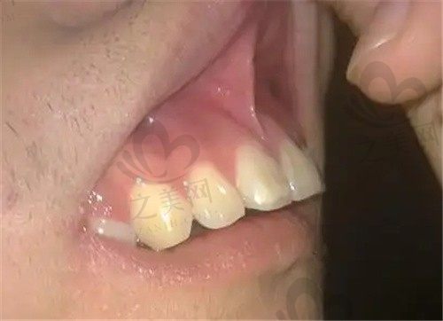 龅牙矫正可以改善凸嘴吗?会改变脸型吗?成年了还可以矫正吗