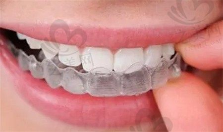 金属托槽矫正和隐形矫正哪个好?矫正下来要花费多少钱?