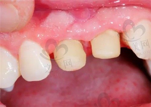 烤瓷牙套里的牙会烂吗?烤瓷牙掉了怎么办可以粘回去吗?