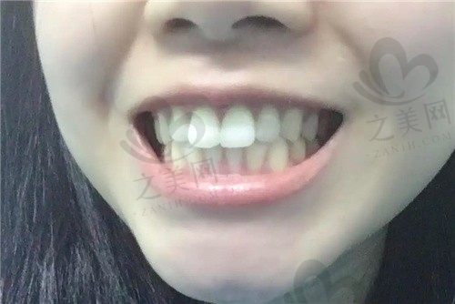 只有一颗门牙突出可以怎么矫正?要是门牙有点龅牙能磨平吗