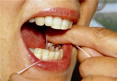牙松动厉害必须拔掉吗?牙拔了三年了还可以种植吗?