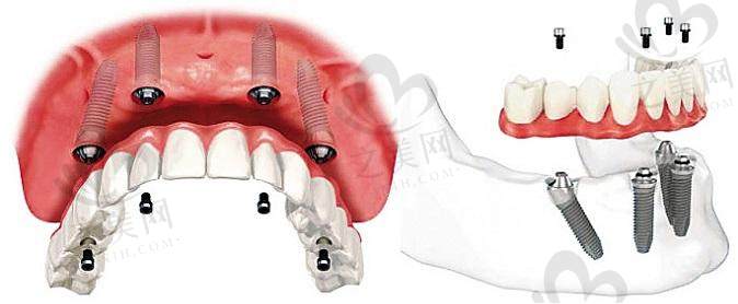 种植牙作为被认可的“人类第三副牙齿”