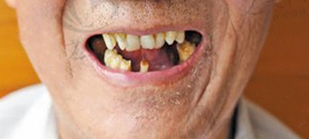 种植牙：因牙周疾病牙齿脱落