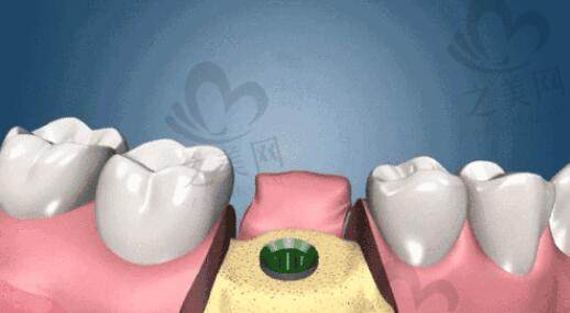 牙齿种植基桩演示