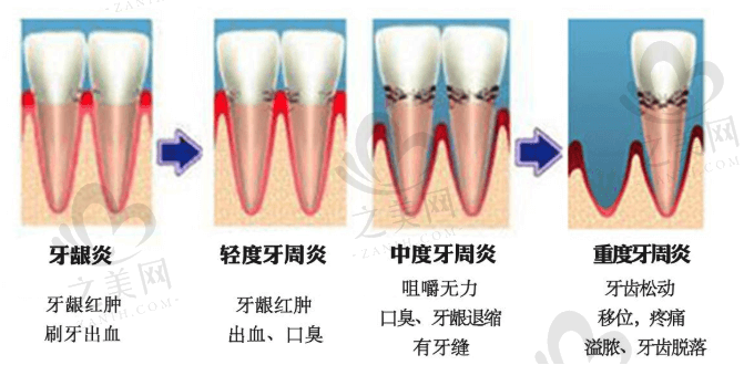 牙周炎.png