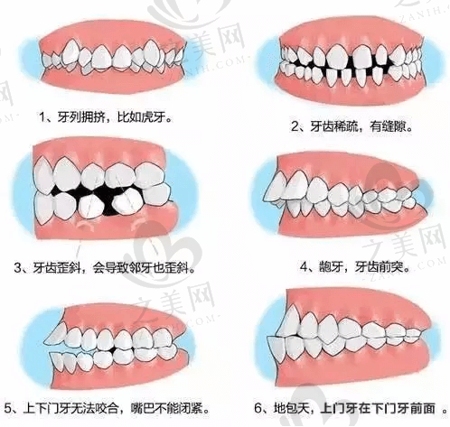 需要矫正的口腔牙齿.png