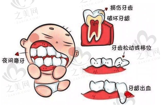 牙磨牙症.png