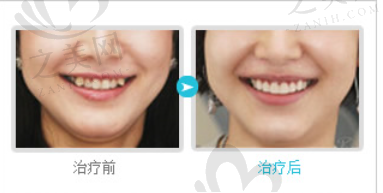 牙齿不整齐做传统矫正、半隐形、隐形矫正有什么区别?