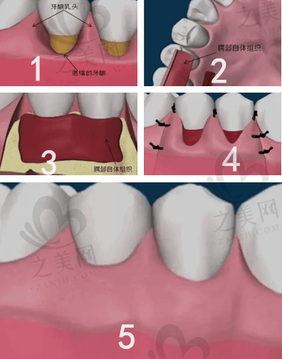 牙周软组织整形手术