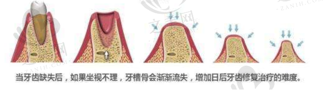 牙槽骨骨量