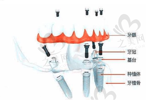 北京劲松口腔全口种植牙效果怎么样？
