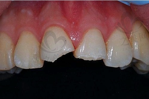 门牙缺损如何修复？