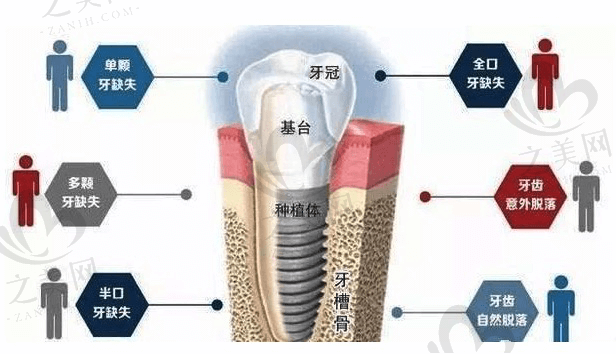北京牙管家种植牙技术到底怎么样?