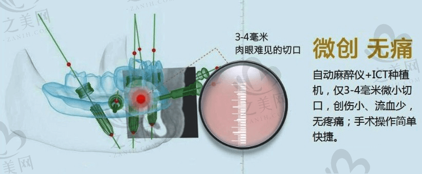 微创种植牙和普通种植牙有什么区别呢？