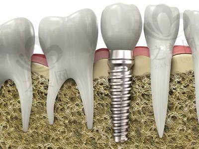 种植牙刨面图