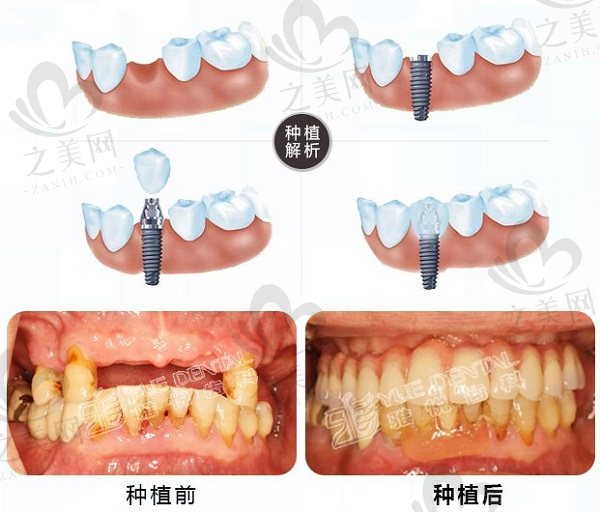 上海雅悦齿科种植牙效果图