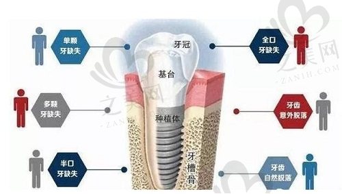 种植牙适合人群