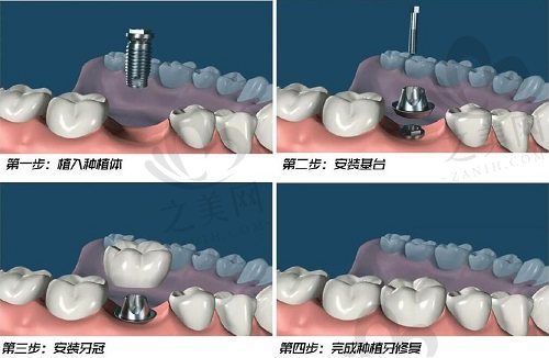 种植牙手术步骤