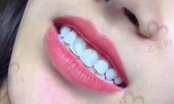 牙黄要怎么变白,牙齿美白选冷光美白好还是牙齿贴面好?