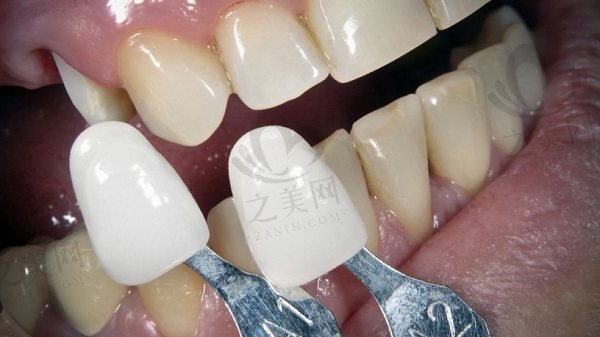 牙齿贴面效果怎么样?哪些情况可以做牙贴面修复呢?