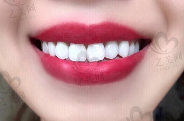 牙齿冷光美白可以保持多久？