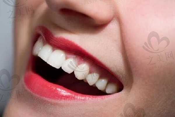 牙齿冷光美白有哪些优缺点,可以保持多久?