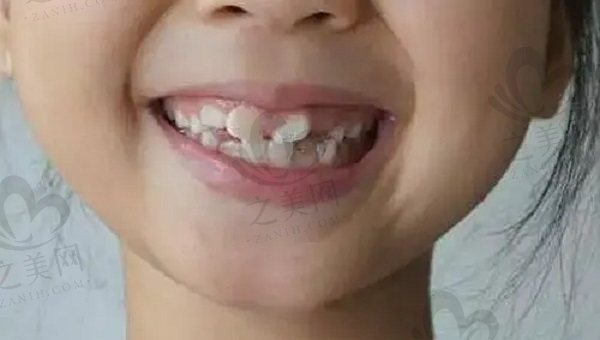 小孩做牙齿矫正医生为什么不建议戴隐形牙套呢?