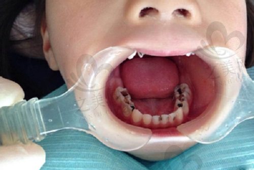 孩子乳牙长虫牙