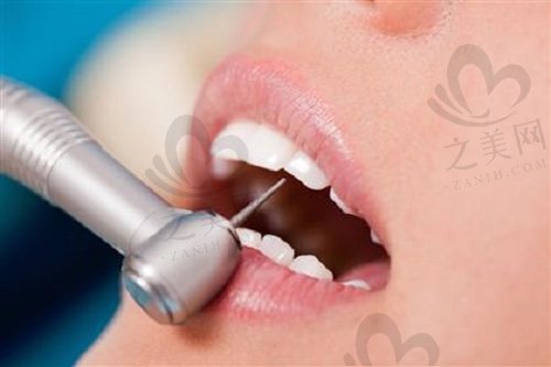 洗牙对牙齿有伤害吗?会让牙缝变大、牙齿变松动吗?