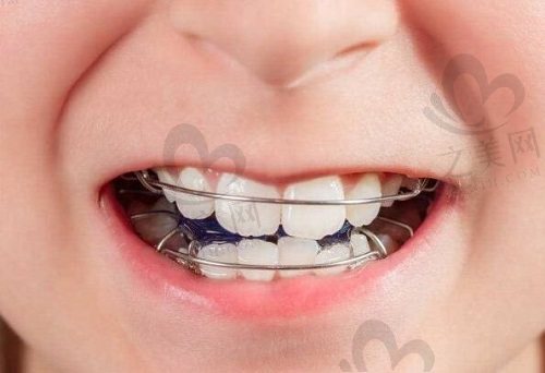 儿童牙齿畸形矫正