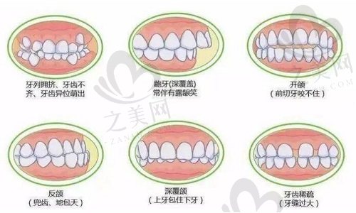牙齿各类畸形情况