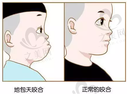 乳牙反颌(“地包天”)真的不用管吗?反颌什么时间矫正好?