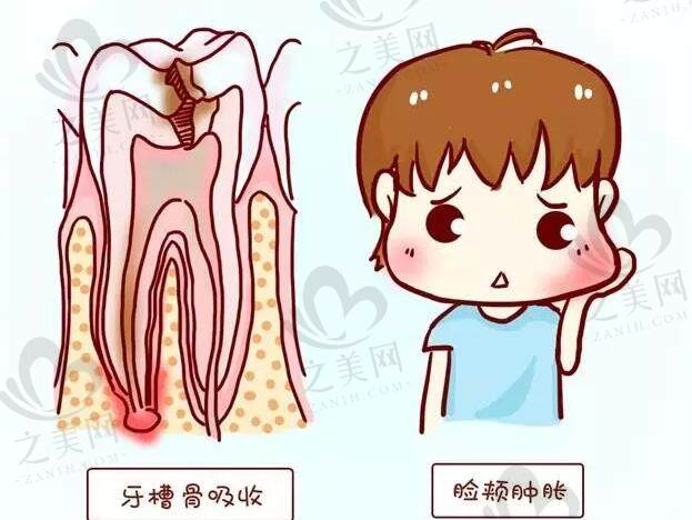 乳牙根管治疗有危害或后遗症