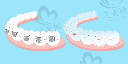 牙齿矫正器种类