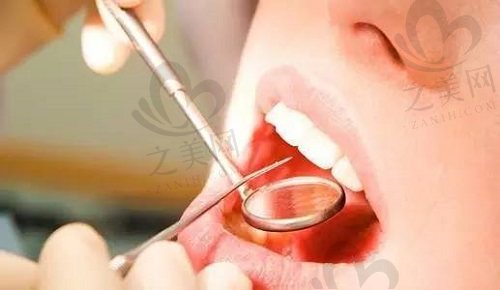 种植牙术后要定期复诊