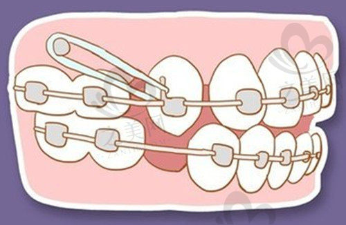 牙齿矫正动画示意图