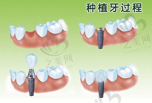 种植牙过程