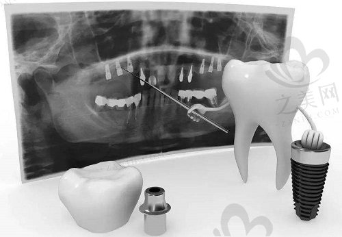 种植牙拍片检查