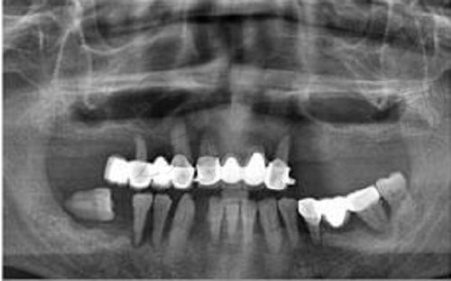 种植牙拍片检查