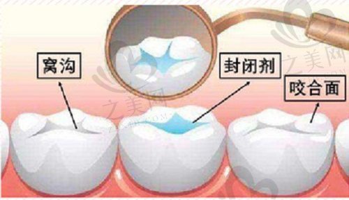 窝沟封闭示意图