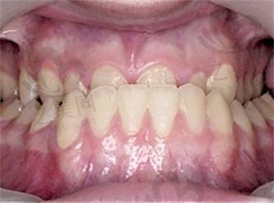 儿童牙齿畸形2.jpg