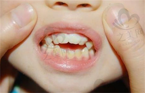 儿童牙齿不齐示意图